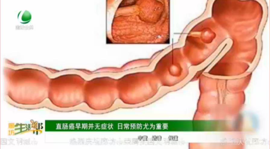 直腸癌早期并無癥狀 日常預(yù)防尤為重要